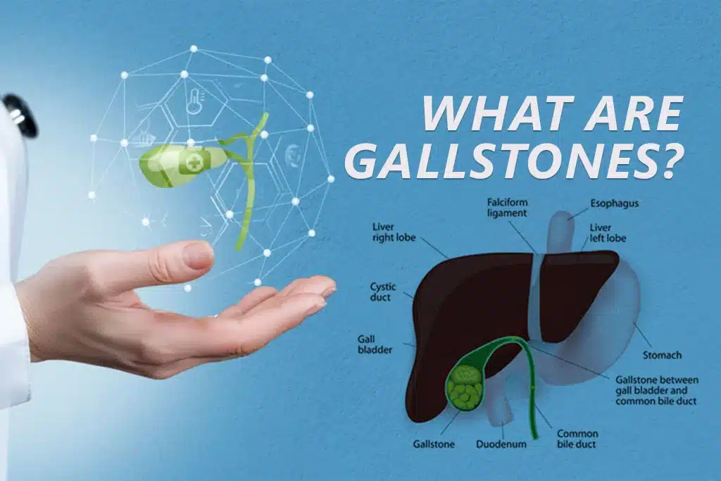 gallstones and digestion problems