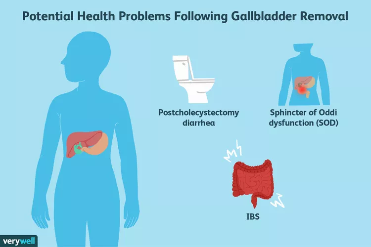Gallbladder Weight Gain