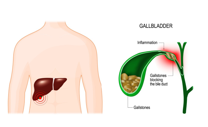 Can Gallstones Cause Weight Gain