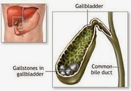 Can Gallstones Cause Weight Gain
